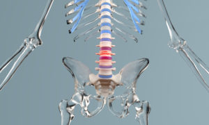The image shows a 3d rendering of a glass skeleton with a spinal compression fracture to explain the reasons to treat spinal stenosis.