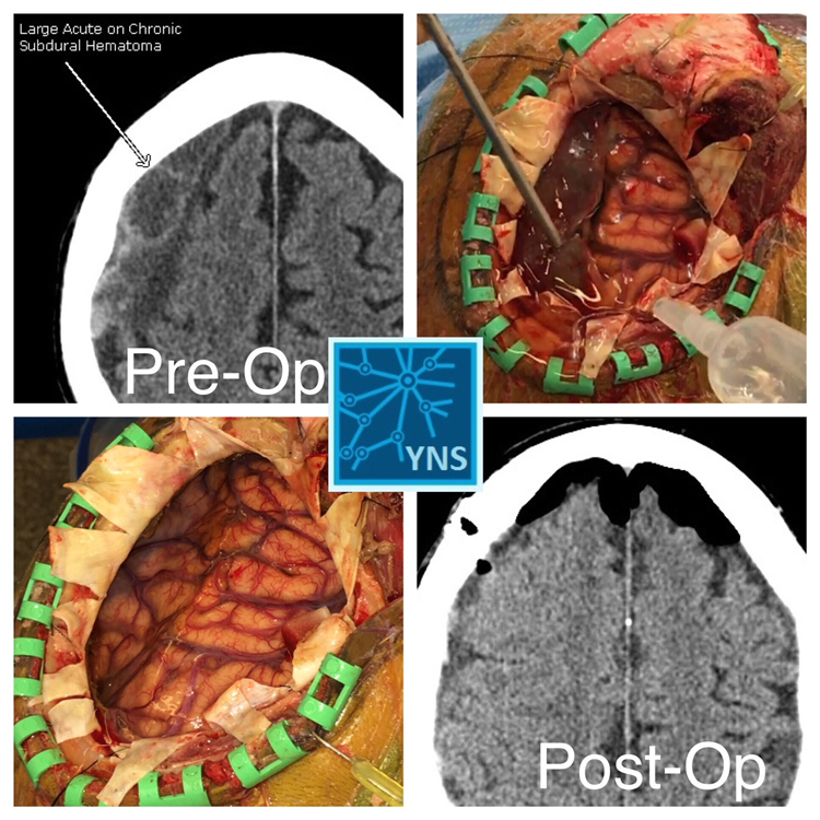 Pre-Op and Post-Op CT scan as well as intra-operative view of a large subdural hematoma