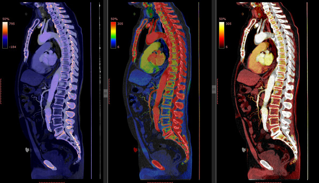 The image shows different scans of a person's abdomen with the spine visible. It serves to show the benefits of discectomy surgery.
