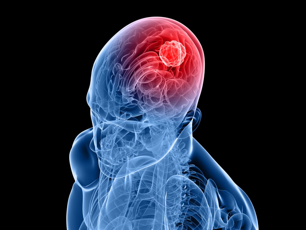 can-you-feel-a-brain-tumor-yashar-neurosurgery-blog