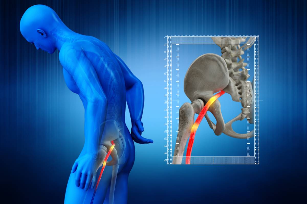 concept of warning signs of sciatica