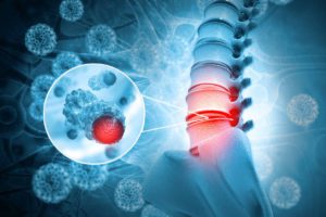 concept of early warning signs of spine tumors