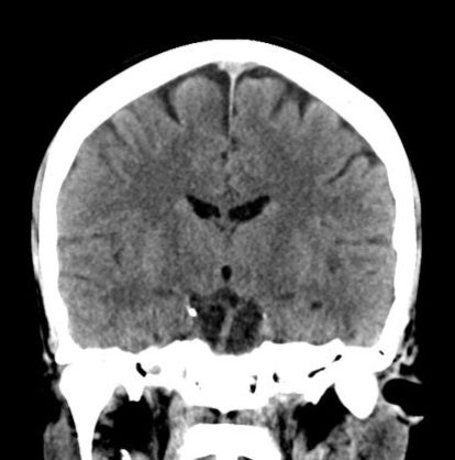 CT-scan Image4
