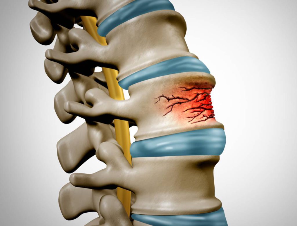 How Are Compression Fractures Treated? | Yashar Neurosurgery - Blog