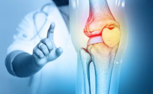 How Common is Osteoarthritis?
