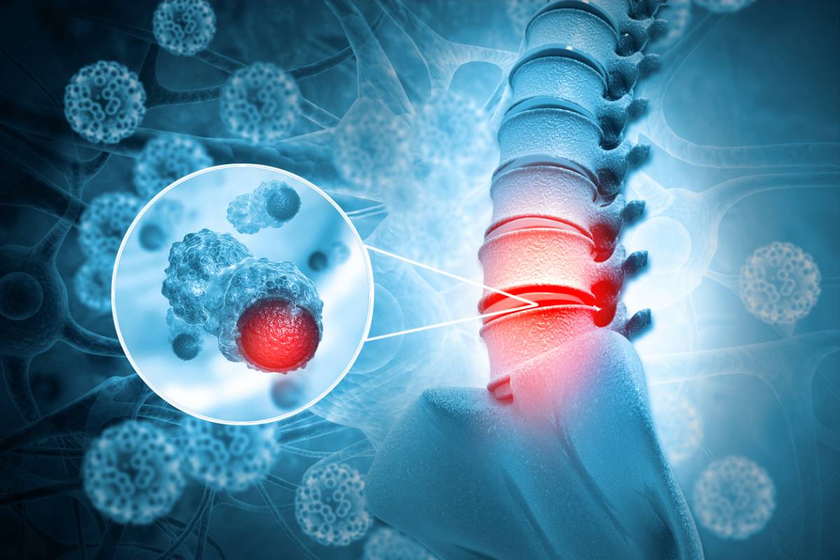 concept image of spinal cancer risk factors