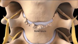 concept of bone spurs that need repair surgery