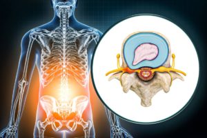 Top Risk Factors for a Herniated Disc
