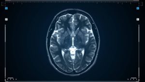 concept image for types of meningioma