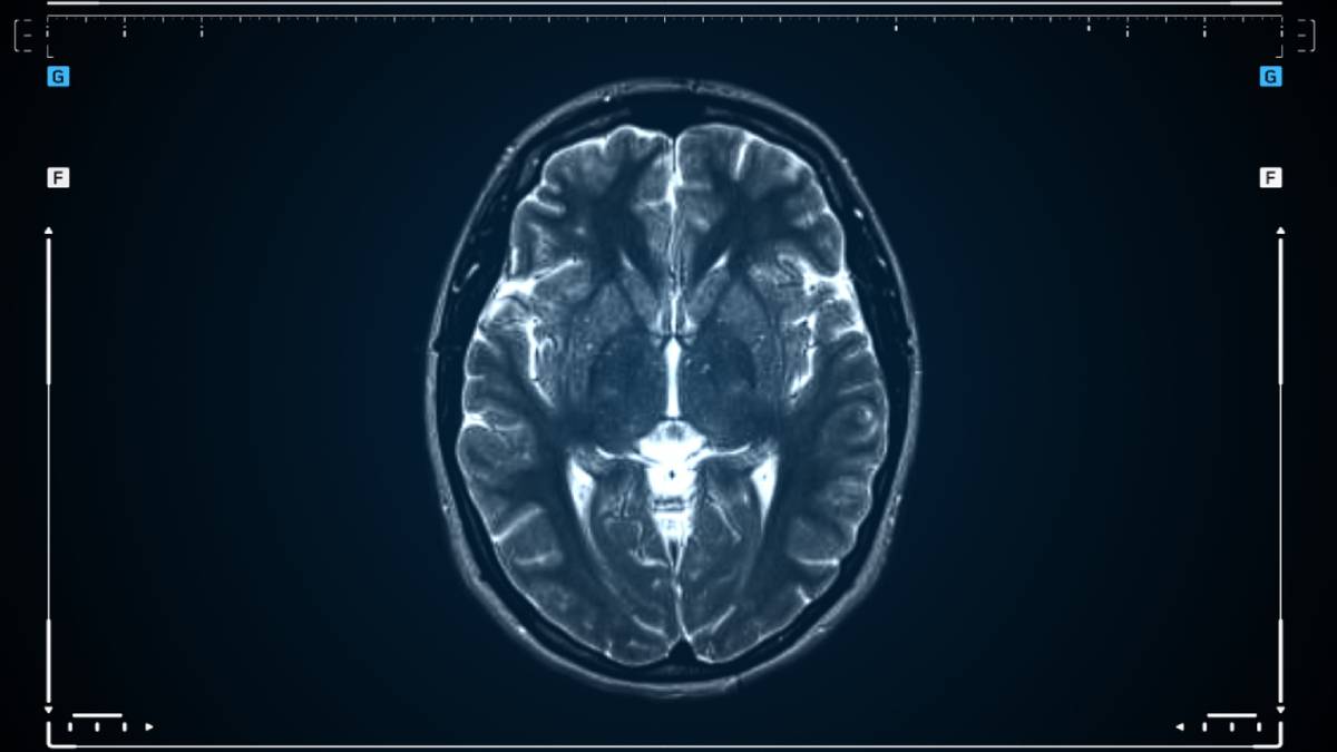 concept image for types of meningioma