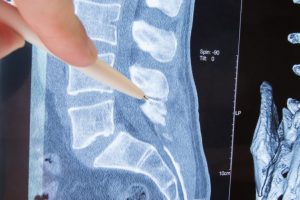Does Spinal Stenosis Go Away?