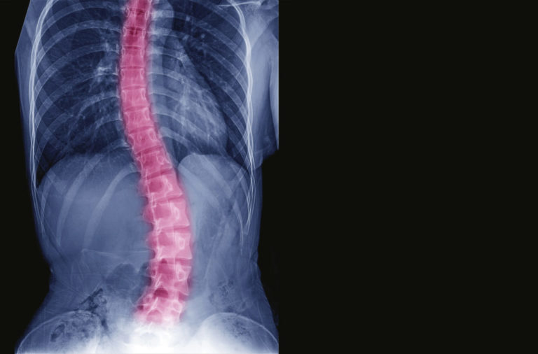 X-ray image of teenager patient spine show Scoliosis and spinal bend in young people. Process in blue tone spine mark in red color and have copy space, Medical concept.?